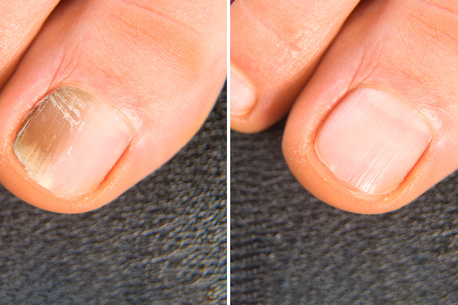 Acrylic nails are causing infections