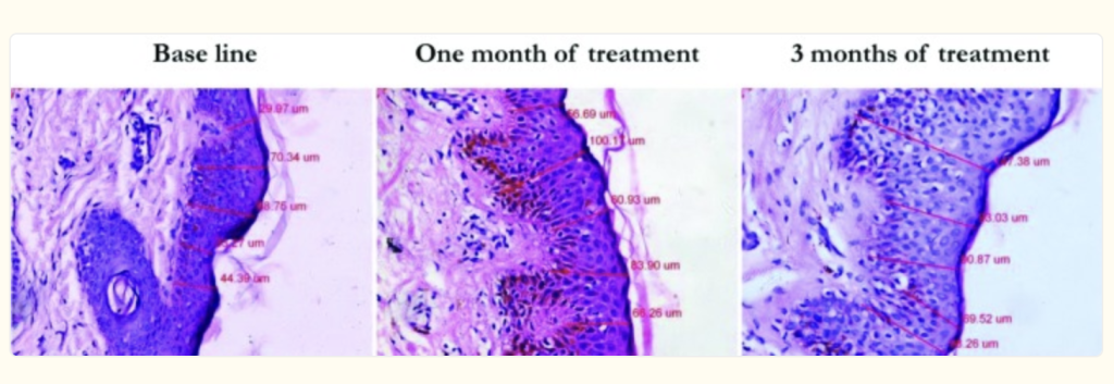 image2 - Kulani Spa Three stained tissue sections labeled Baseline, One month of treatment, and 3 months of treatment, showing changes over time with measurement markers along the tissue edge.