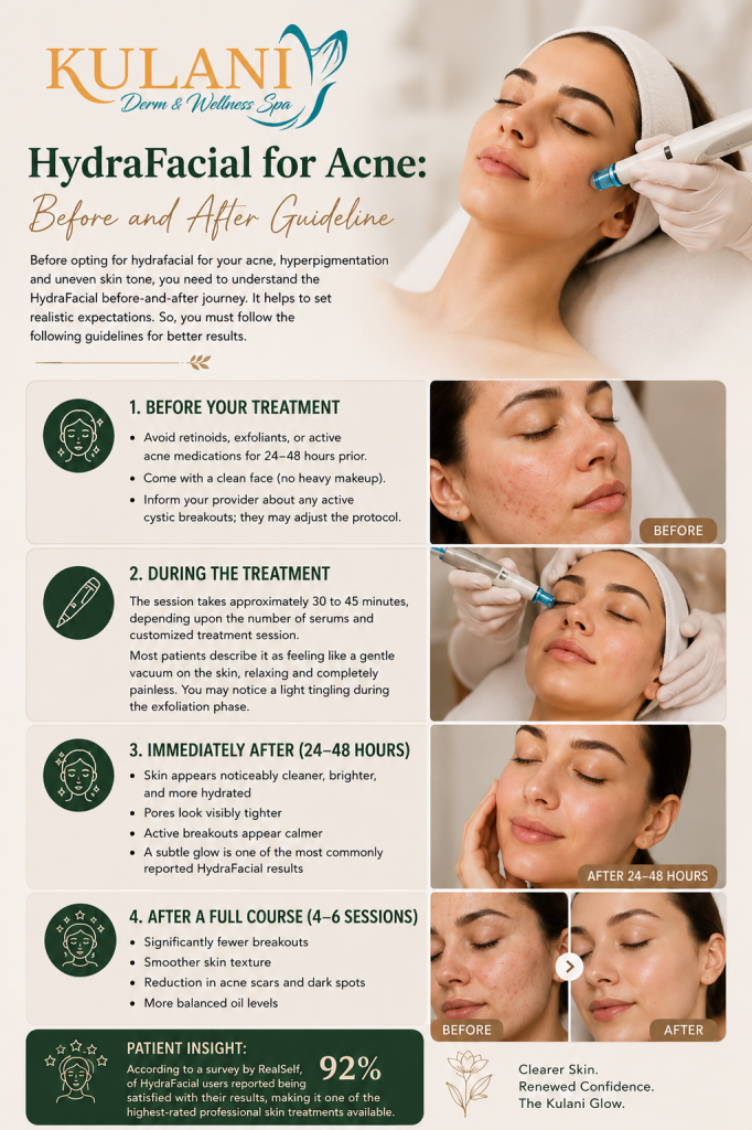 Poster for Kulani Derm & Wellness Spa advertising HydraFacial for acne with a before-and-after guide and four treatment steps, shown with a patient receiving a facial.