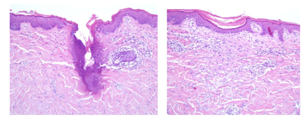 image7 - Kulani Spa Two adjacent microscopic skin sections showing a wound with epidermal disruption and inflammatory infiltrate in the dermis, stained pink and purple with H&E stains.