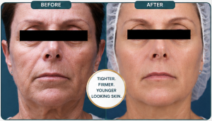 Venus Legacy treatment